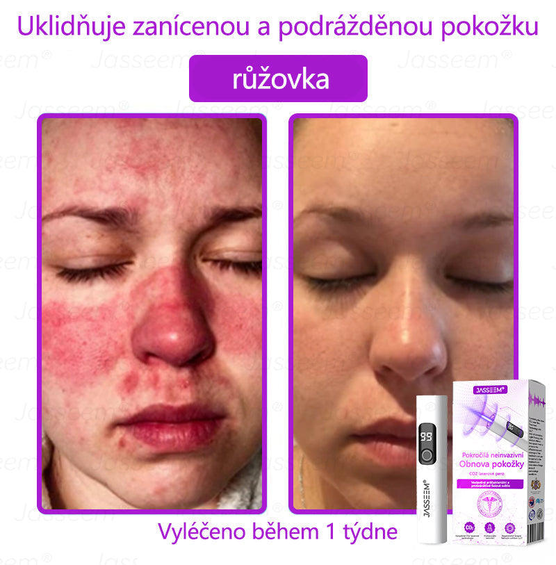 🌿𝐉𝐚𝐬𝐬𝐞𝐞𝐦® Pokročilé neinvazivní pero s CO₂ laserem na opravu pokožky 💕 (šetrně odstraňuje bradavice, mateřská znaménka, stařecké skvrny a kožní značky - bez bolesti a rozruchu!) 🔥