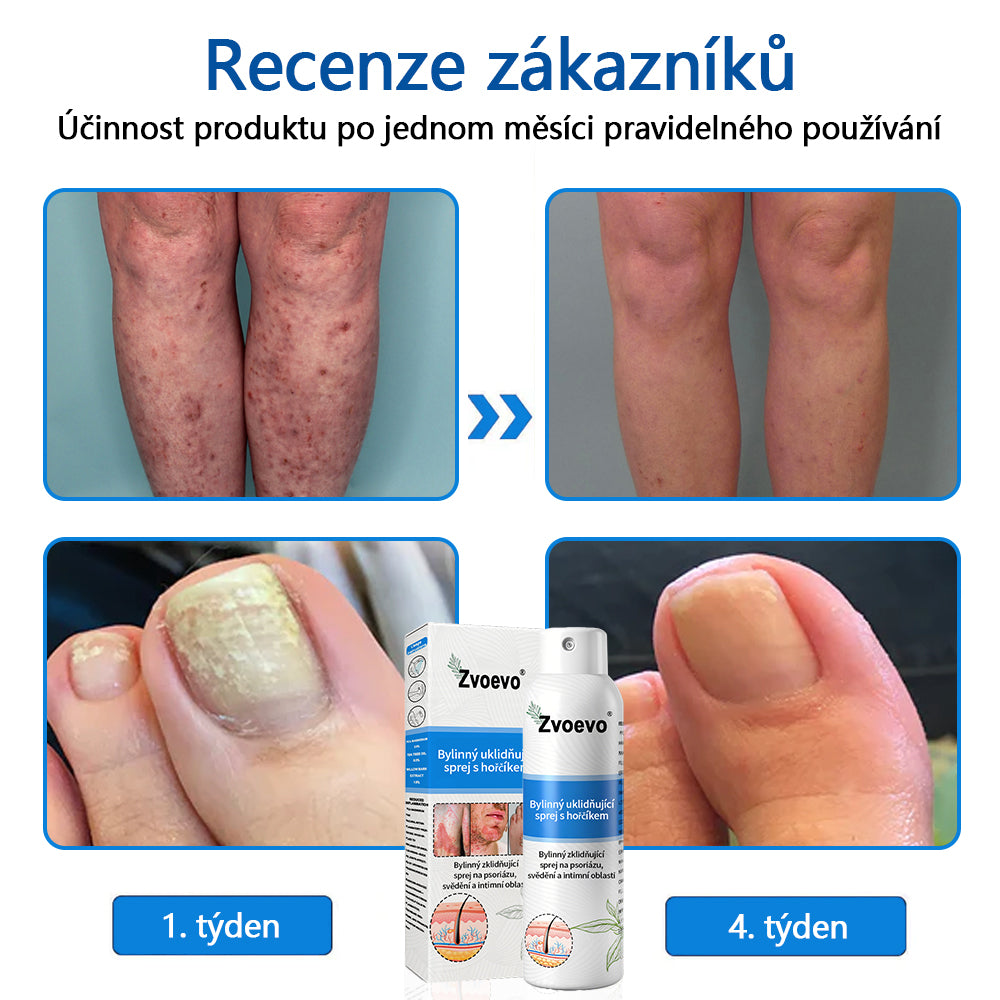 ✅ Oficiální obchod: Zvoevo® Magnesium bylinný sprej na lupénku ⚕️ EMA certifikace (zmírňuje lupénku a ekzém, léčí akné a bradavice, podporuje hojení bakteriálních infekcí, snižuje kloubní a neuropatickou bolest) 🌿