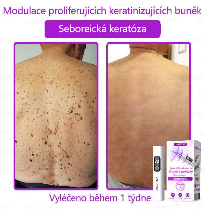 🌿𝐉𝐚𝐬𝐬𝐞𝐞𝐦® Pokročilé neinvazivní pero s CO₂ laserem na opravu pokožky 💕 (šetrně odstraňuje bradavice, mateřská znaménka, stařecké skvrny a kožní značky - bez bolesti a rozruchu!) 🔥