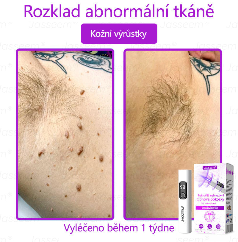 🌿𝐉𝐚𝐬𝐬𝐞𝐞𝐦® Pokročilé neinvazivní pero s CO₂ laserem na opravu pokožky 💕 (šetrně odstraňuje bradavice, mateřská znaménka, stařecké skvrny a kožní značky - bez bolesti a rozruchu!) 🔥