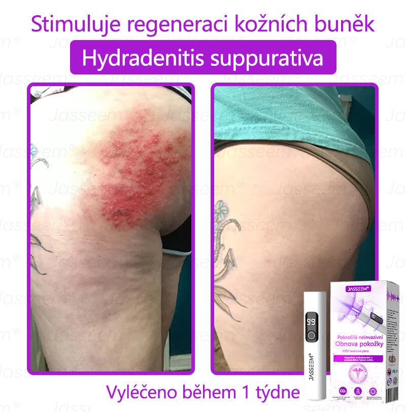 🌿𝐉𝐚𝐬𝐬𝐞𝐞𝐦® Pokročilé neinvazivní pero s CO₂ laserem na opravu pokožky 💕 (šetrně odstraňuje bradavice, mateřská znaménka, stařecké skvrny a kožní značky - bez bolesti a rozruchu!) 🔥