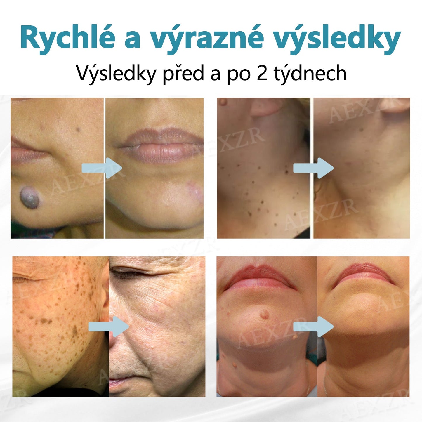 Foulme® PRO Neinvazivní laserové pero na odstraňování bradavic a znamének 🛒