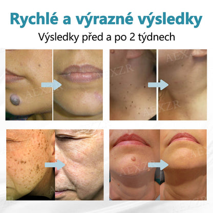 Foulme® PRO Neinvazivní laserové pero na odstraňování bradavic a znamének 🛒