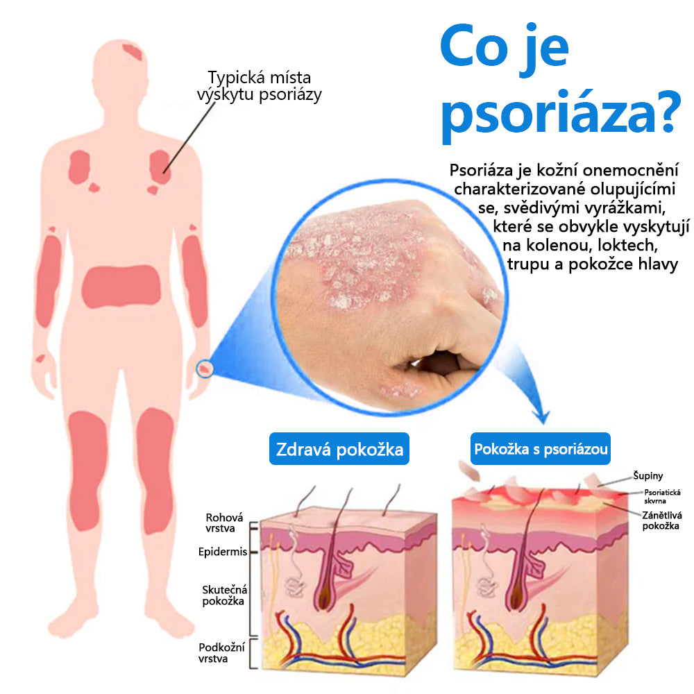 ✅ Oficiální obchod: Zvoevo® Magnesium bylinný sprej na lupénku ⚕️ EMA certifikace (zmírňuje lupénku a ekzém, léčí akné a bradavice, podporuje hojení bakteriálních infekcí, snižuje kloubní a neuropatickou bolest)  🛒