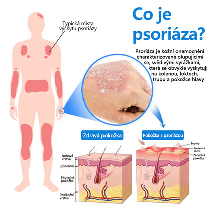 ✅ Oficiální obchod: Zvoevo® Magnesium bylinný sprej na lupénku ⚕️ EMA certifikace (zmírňuje lupénku a ekzém, léčí akné a bradavice, podporuje hojení bakteriálních infekcí, snižuje kloubní a neuropatickou bolest)  🛒