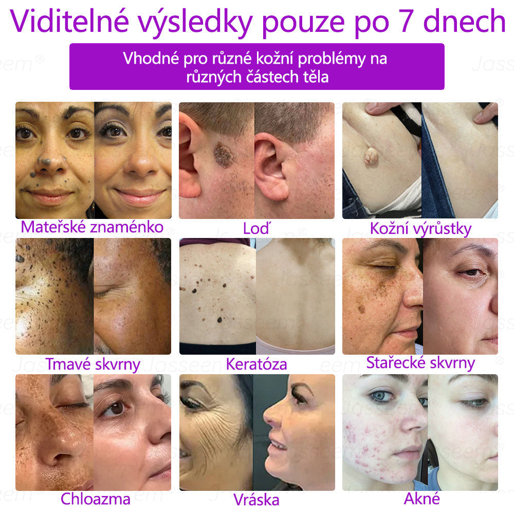 🌿𝐉𝐚𝐬𝐬𝐞𝐞𝐦® Pokročilé neinvazivní pero s CO₂ laserem na opravu pokožky 💕 (šetrně odstraňuje bradavice, mateřská znaménka, stařecké skvrny a kožní značky - bez bolesti a rozruchu!) 🔥
