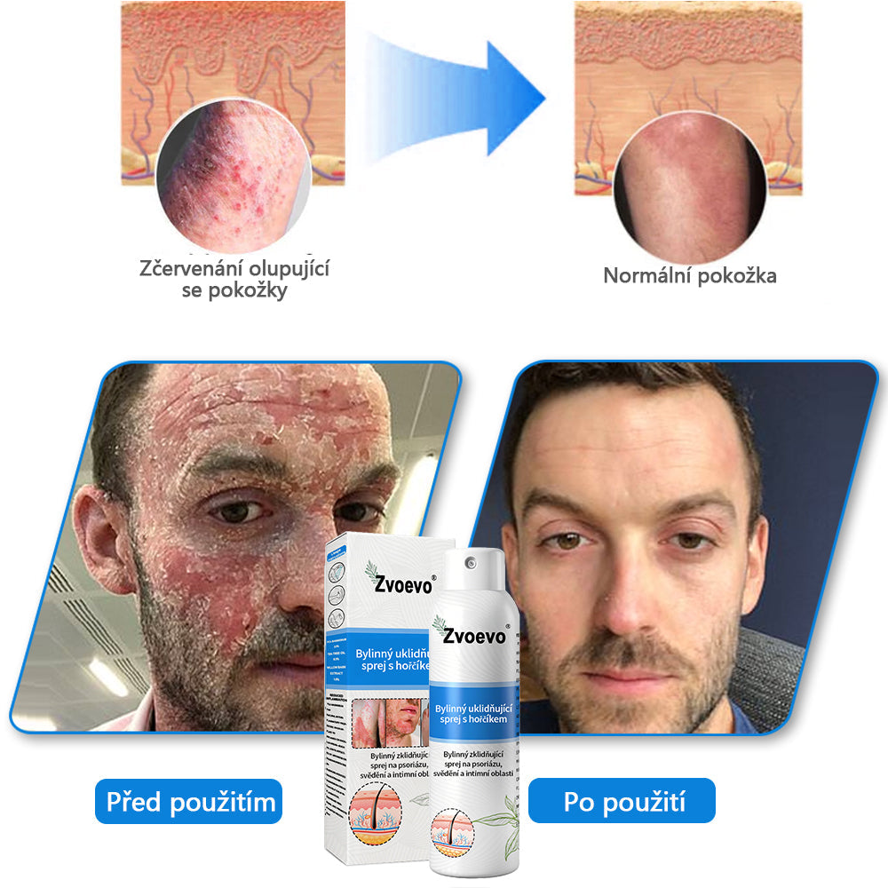 ✅ Oficiální obchod: Zvoevo® Magnesium bylinný sprej na lupénku ⚕️ EMA certifikace (zmírňuje lupénku a ekzém, léčí akné a bradavice, podporuje hojení bakteriálních infekcí, snižuje kloubní a neuropatickou bolest)  🛒