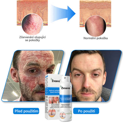 ✅ Oficiální obchod: Zvoevo® Magnesium bylinný sprej na lupénku ⚕️ EMA certifikace (zmírňuje lupénku a ekzém, léčí akné a bradavice, podporuje hojení bakteriálních infekcí, snižuje kloubní a neuropatickou bolest)  🛒