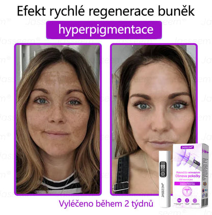 🌿𝐉𝐚𝐬𝐬𝐞𝐞𝐦® Pokročilé neinvazivní pero s CO₂ laserem na opravu pokožky 💕 (šetrně odstraňuje bradavice, mateřská znaménka, stařecké skvrny a kožní značky - bez bolesti a rozruchu!) 🔥