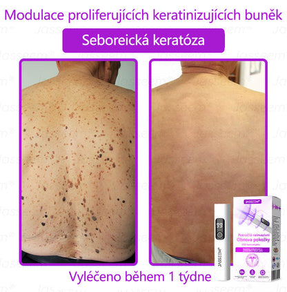 🌿𝐉𝐚𝐬𝐬𝐞𝐞𝐦® Pokročilé neinvazivní pero s CO₂ laserem na opravu pokožky 💕 (šetrně odstraňuje bradavice, mateřská znaménka, stařecké skvrny a kožní značky - bez bolesti a rozruchu!) 🔥