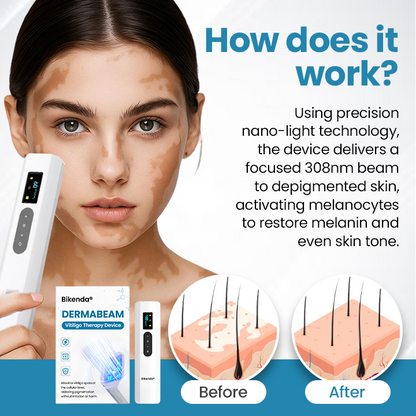Zařízení Bikenda® DermaBeam pro terapii vitiliga💥