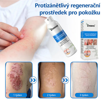 ✅ Oficiální obchod: Zvoevo® Magnesium bylinný sprej na lupénku ⚕️ EMA certifikace (zmírňuje lupénku a ekzém, léčí akné a bradavice, podporuje hojení bakteriálních infekcí, snižuje kloubní a neuropatickou bolest)  🛒