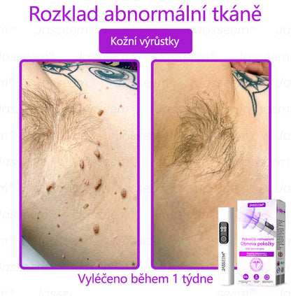 🌿𝐉𝐚𝐬𝐬𝐞𝐞𝐦® Pokročilé neinvazivní pero s CO₂ laserem na opravu pokožky 💕 (šetrně odstraňuje bradavice, mateřská znaménka, stařecké skvrny a kožní značky - bez bolesti a rozruchu!) 🔥